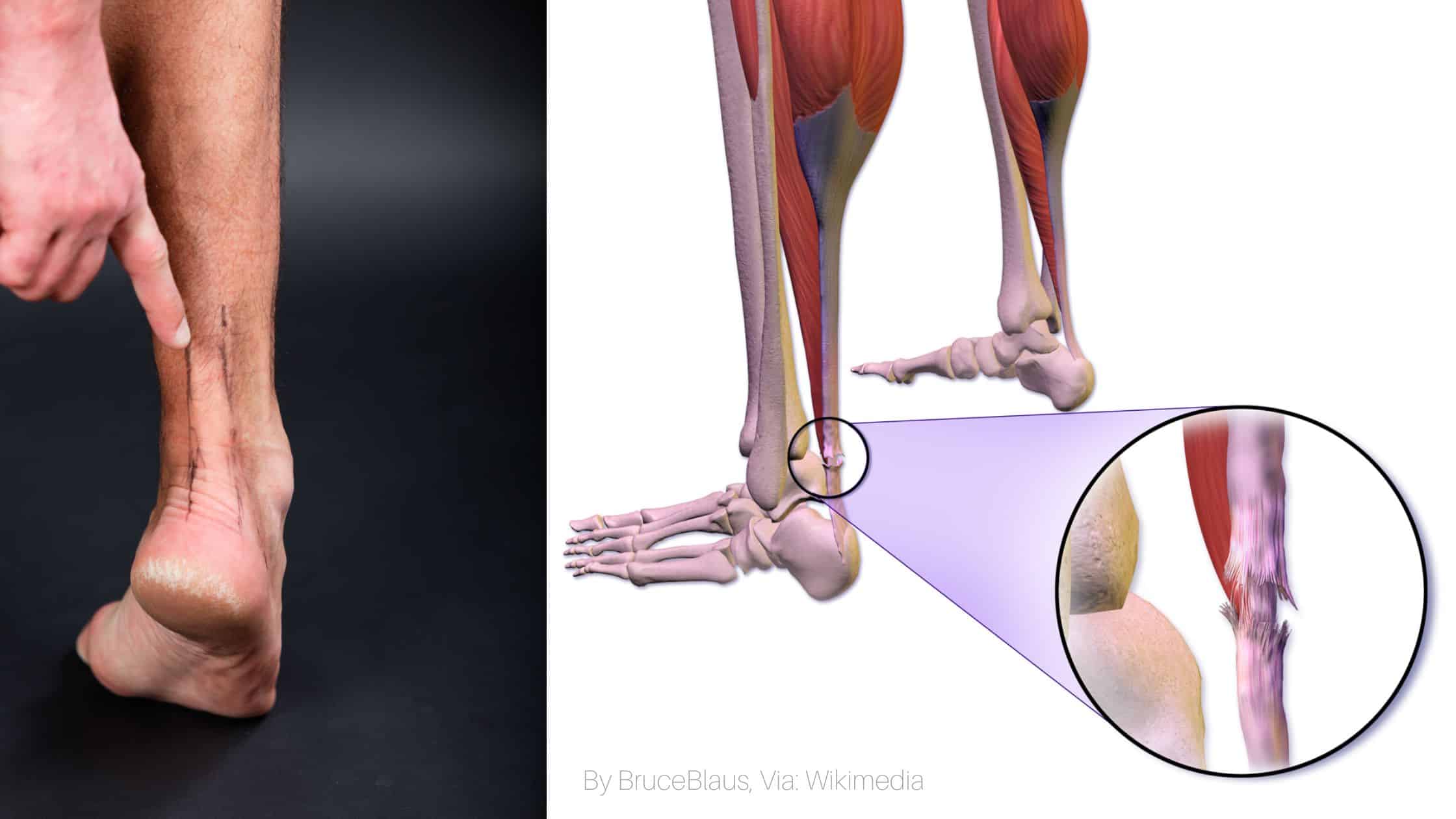 Achilles Rupture Tendon Everything You Should Know